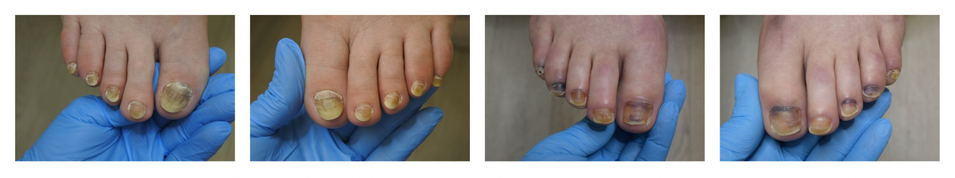 Примеры поражения ногтевых пластин в процессе лечения онкологических заболеваний.jpg