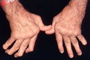 artrit-9