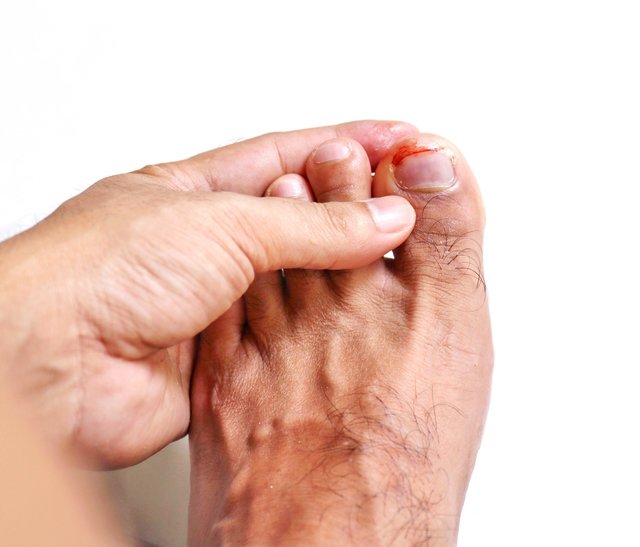 травма ногтя большого пальца ноги