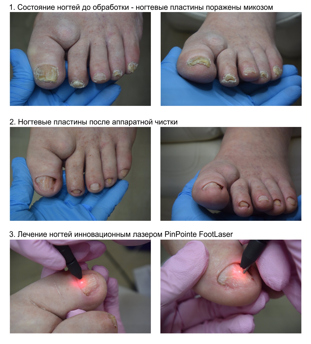 Случай лечения микоза стоп и ногтей на фоне подагры.jpg