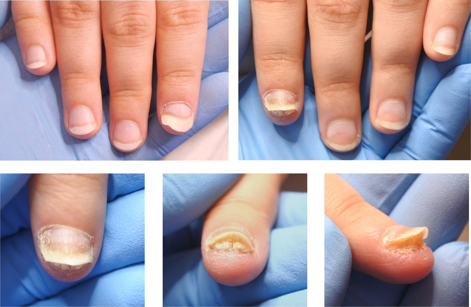 Пример торпидного течения псориаза на ногтевых пластинах кистей рук - несколько примеров.jpg