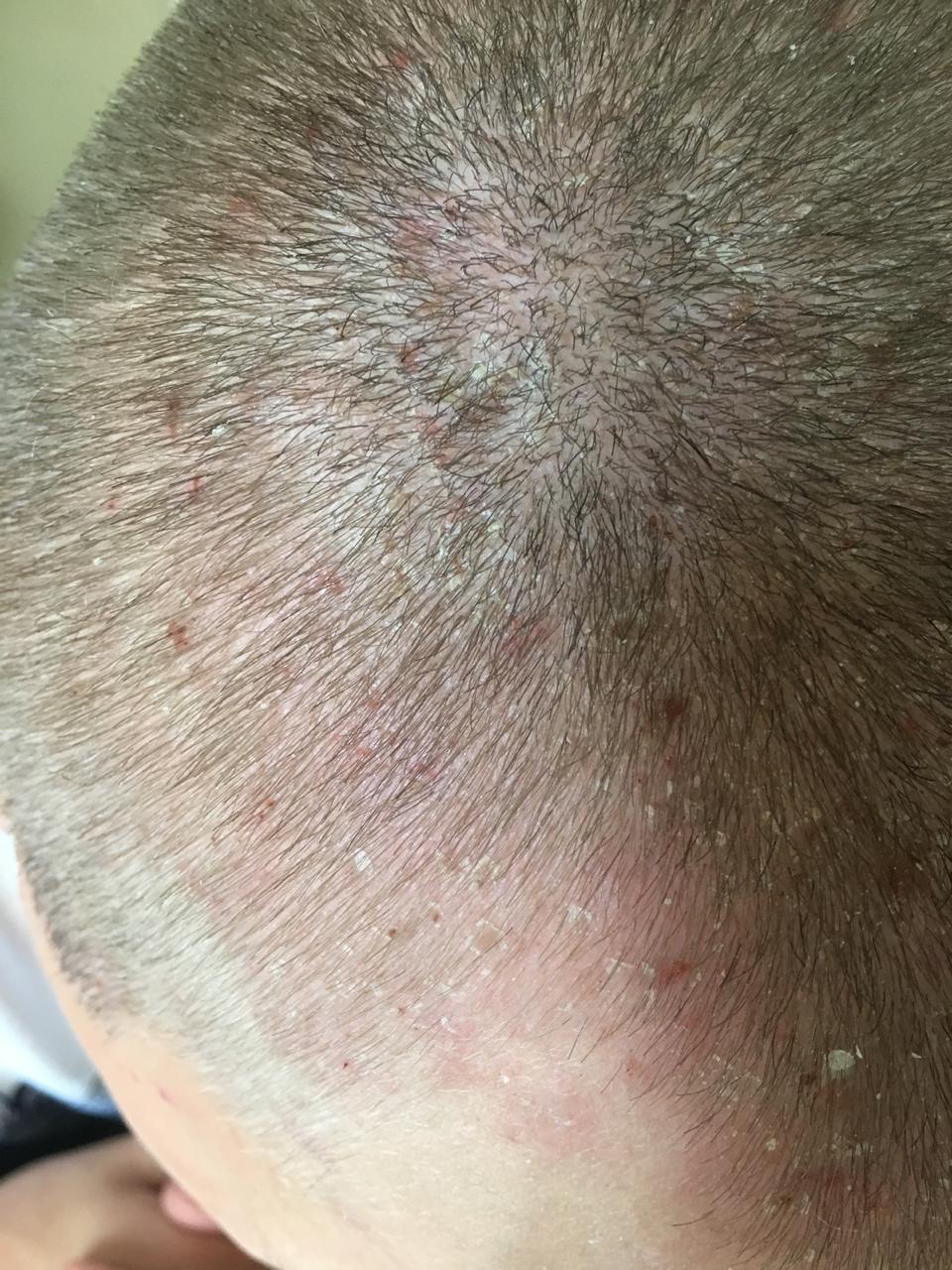 Себорейный дерматит волосистой части головы вид сбоку.jpeg
