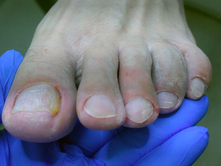 Причины грибка ногтей
