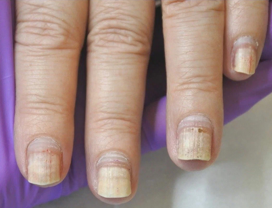 Ногти на руках после химиотерапии
