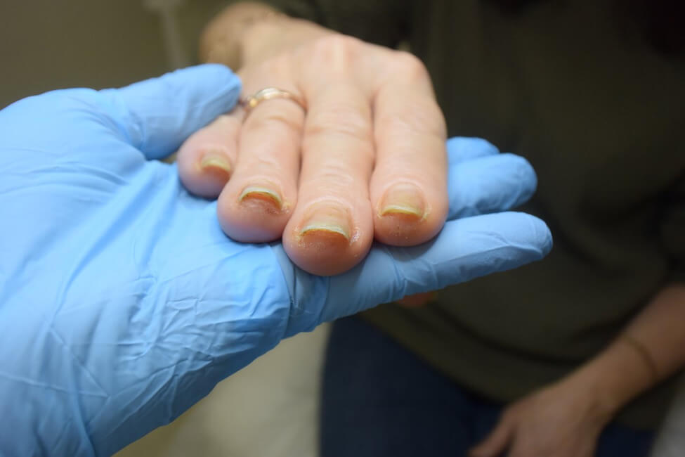 Симптомы псориаза ногтей