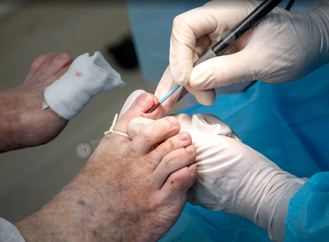 Хирургия ногтя в Клинике Подологии