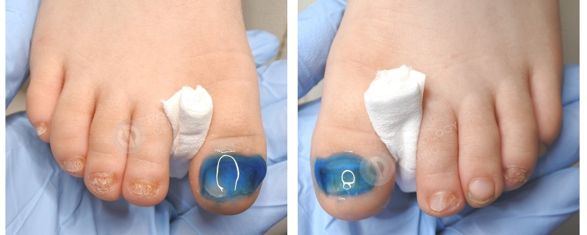 Лечение грибка на ногтях ног фото до и после
