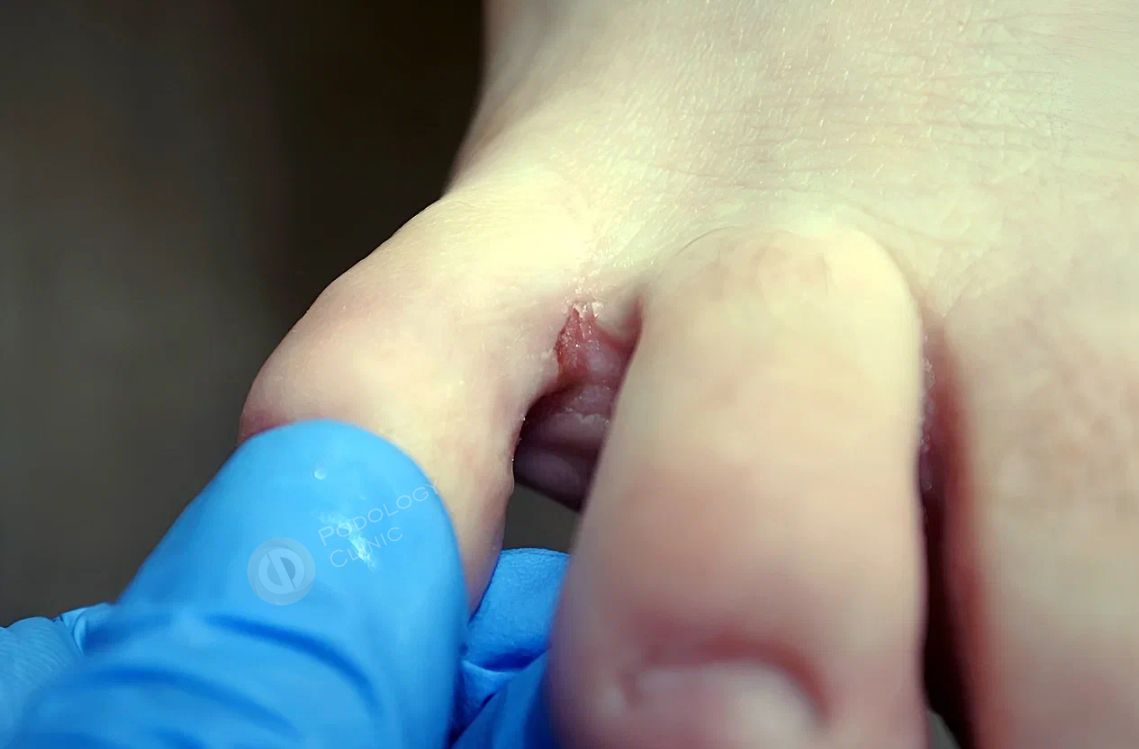 Почему трескаются ногти и кожа вокруг ногтей – причины, лечение и профилактика