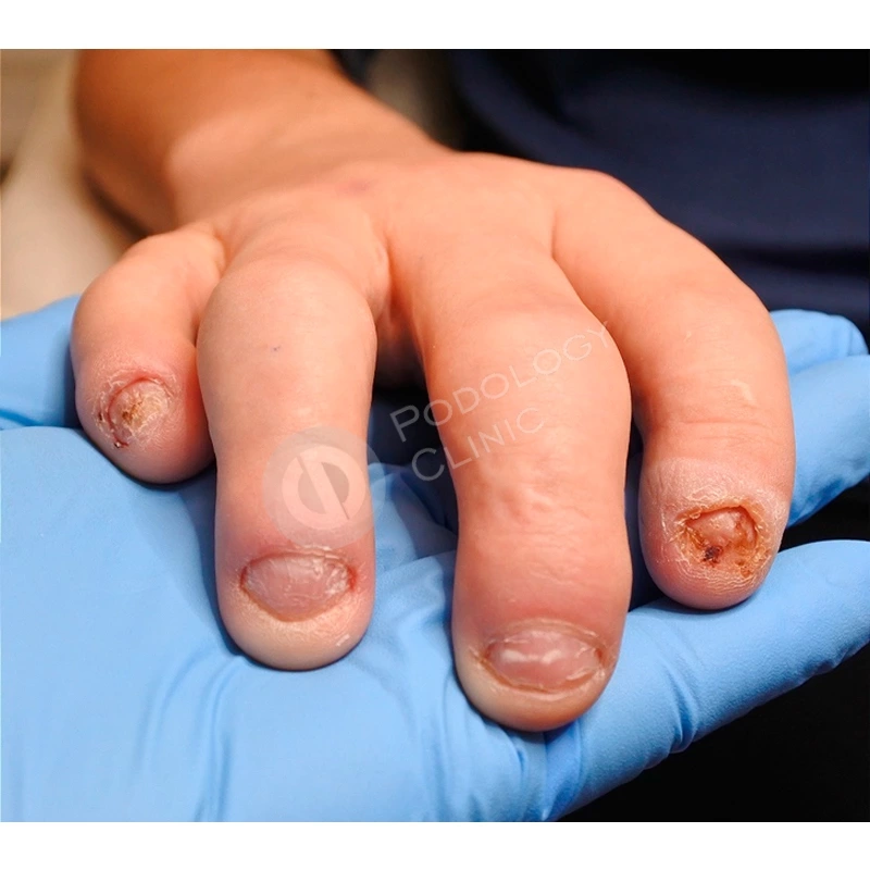 Деформации и дистрофии ногтей