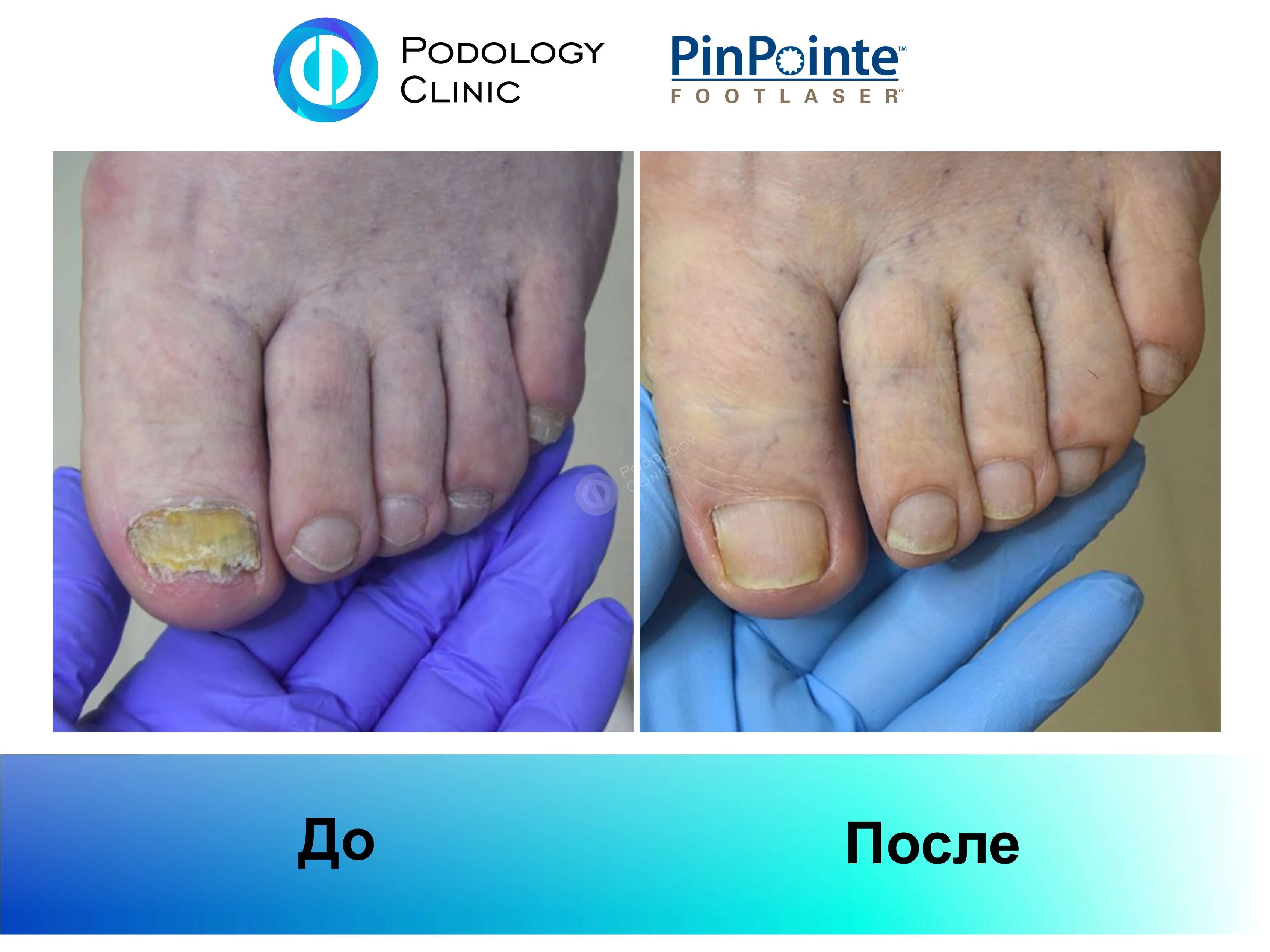 Примеры работы лазера PinPointe FootLaser в лечении онихомикоза, фото 7