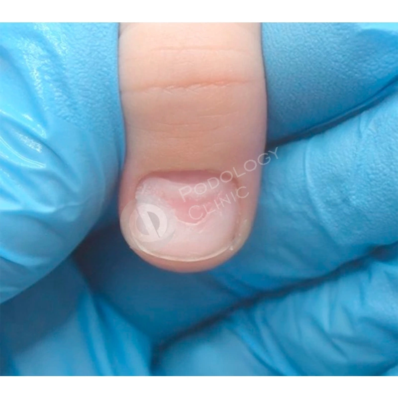 Онихомадезис – отслойка ногтя у основания