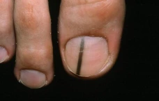 Лечение почерневших ногтей