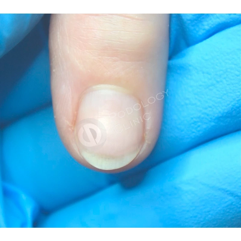 Как восстановить ногти после гель-лака: спасительные советы