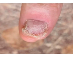 Лечение грибка между пальцами рук