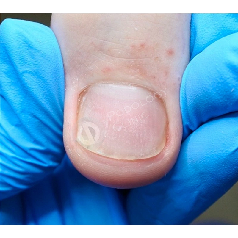 Лечение травмы ногтя