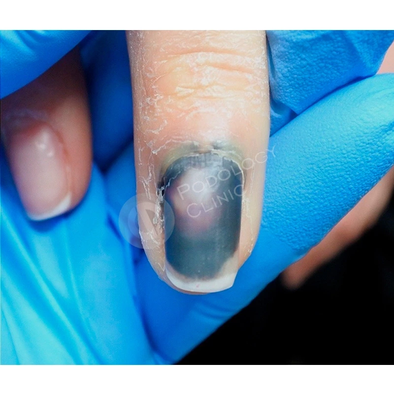 Признаки и способы лечения ушиба ногтевой пластины