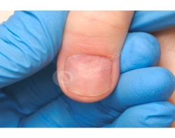 Лечение грибка ногтей (онихомикоз)