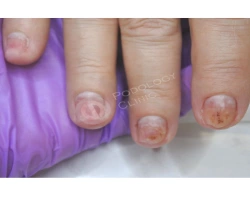Ногти и рак: что делать, если из-за химиотерапии начали разрушаться ногти?