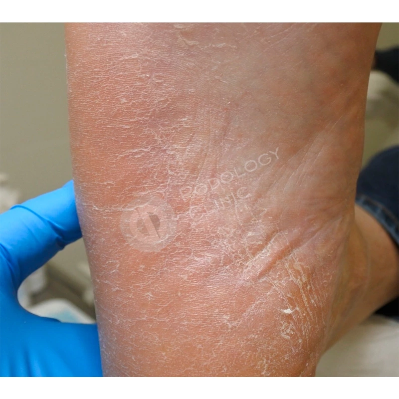 Изменения состояния кожных покровов при лечении рака