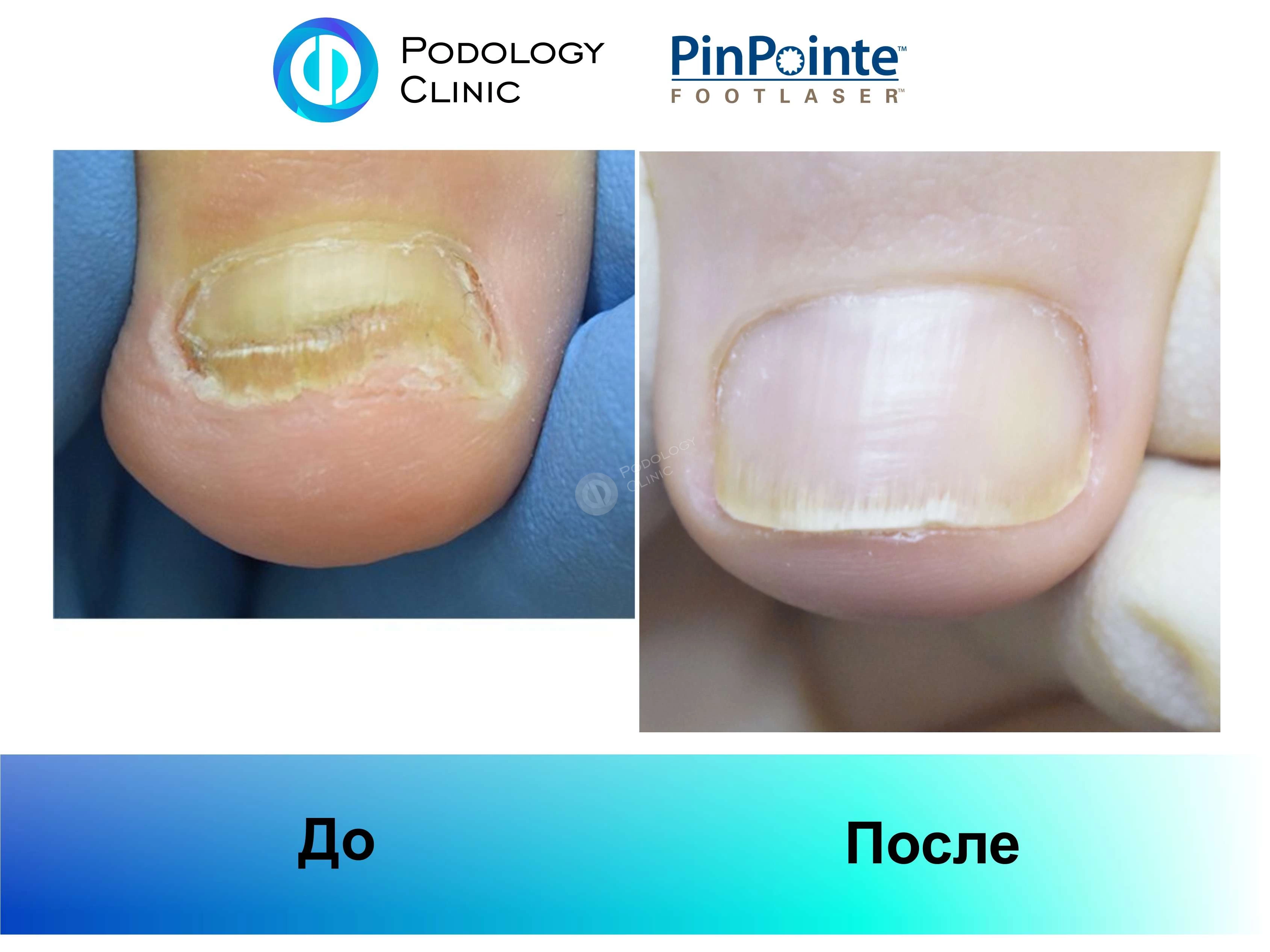 Примеры работы лазера PinPointe FootLaser в лечении онихомикоза, фото 8