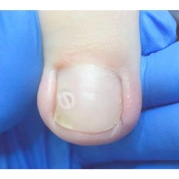 Как избавиться от вросшего ногтя — блог медицинского центра ОН Клиник