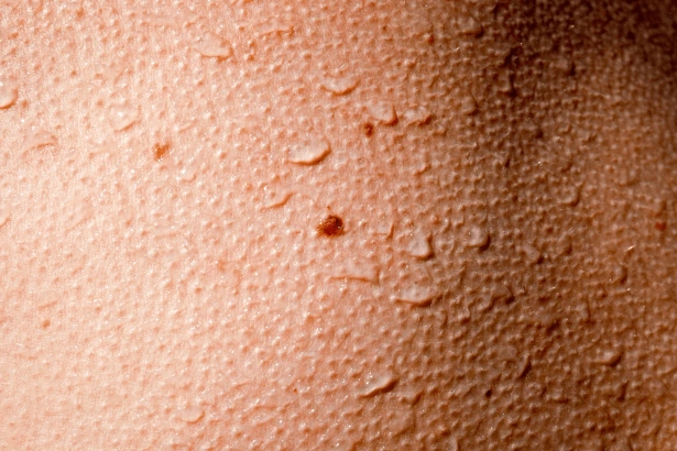 Гусиная кожа — фолликулярный кератоз