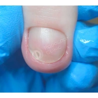 Почему ногти становятся волнистыми и как с этим бороться