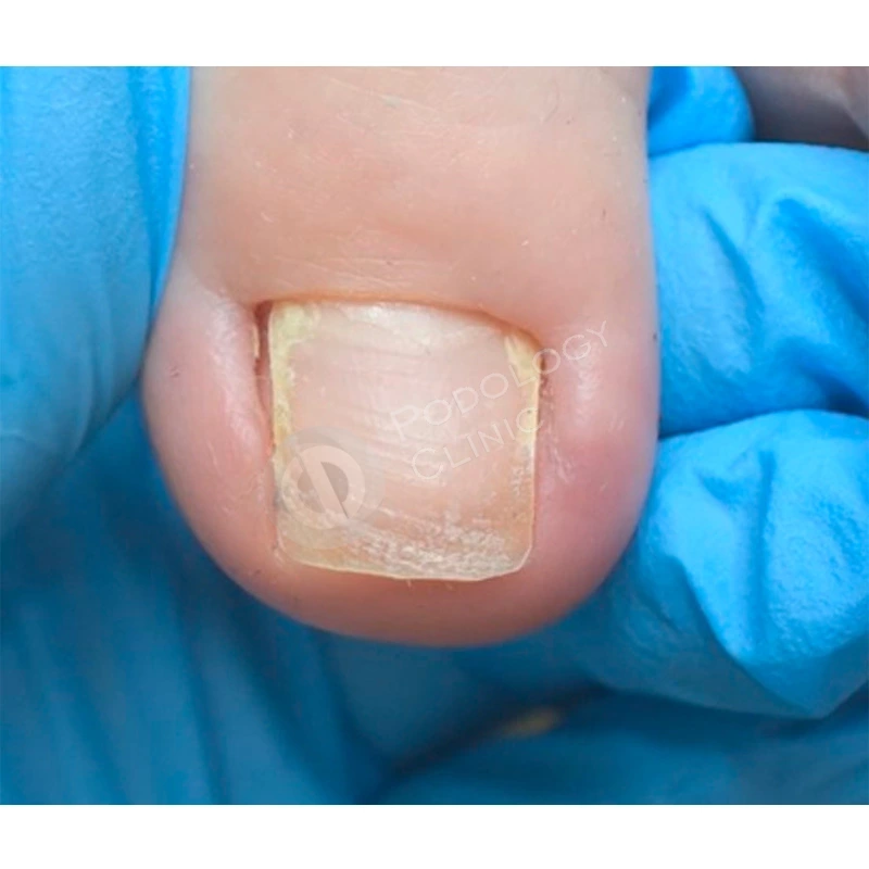 Вросший ноготь и другие проблемы с ногтями младенцев