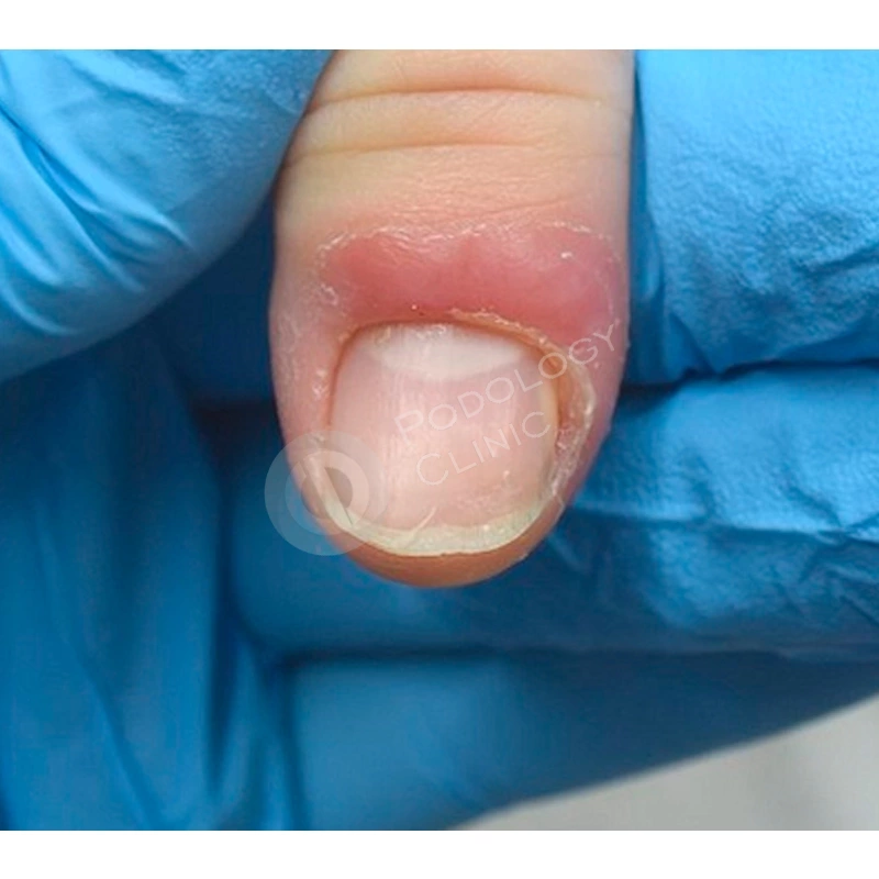 Как проводится лечение ногтевого панариция?