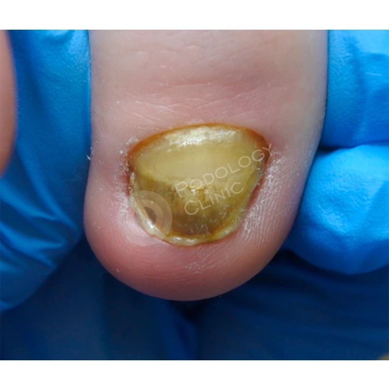 Неровная ногтевая пластина: причины и лечение