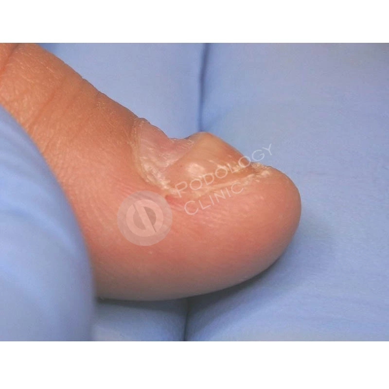 Причины расслоения ногтевой пластины