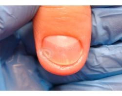 Онихомикоз (грибок ногтей): причины, симптомы и лечение в статье клиники «СОВА»