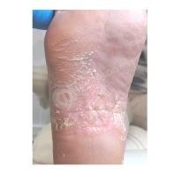 Application of tiloron for the treatment of microbial eczema complicated by trophic ulcers