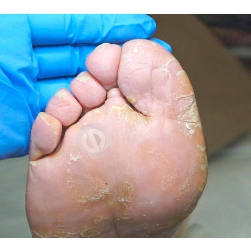 Диагностика и лечение трещин на стопах ног
