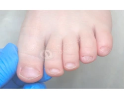 Микозы: симптомы, лечение и профилактика грибка ногтей и кожи