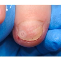 Почему появляются продольные борозды на ногтях и как от них избавиться?
