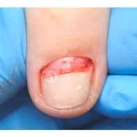 Воспаление ногтевого ложа: лечение, причины и диагностика воспаления