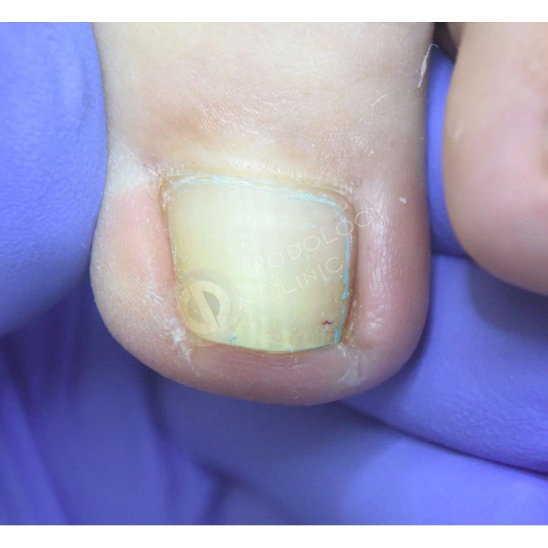 Причина и лечение сухих ногтей
