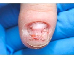 Как выглядит и сходит гематома под ногтем?