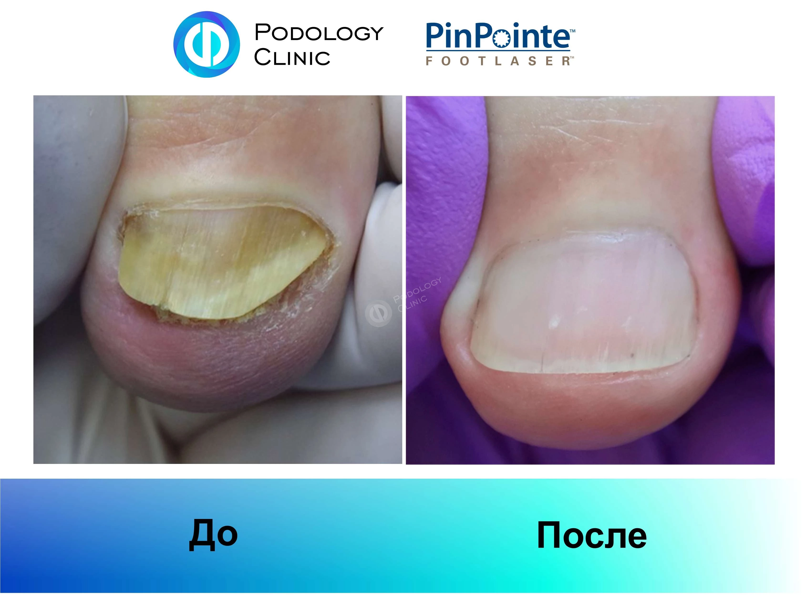 Примеры работы лазера PinPointe FootLaser в лечении онихомикоза, фото 1