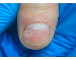 12 методов лечения и восстановления ногтей