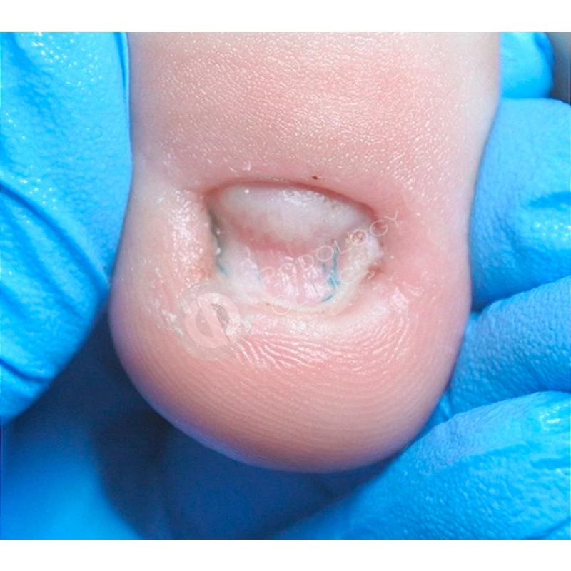 Заболевания ногтевых пластин у детей - Вирилис