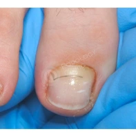 Лечение травмы ногтя на ноге: ушибы, гематомы – как лечить повреждения ногтя