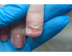 Клиническая симптоматика микозов рук, ног и ногтей