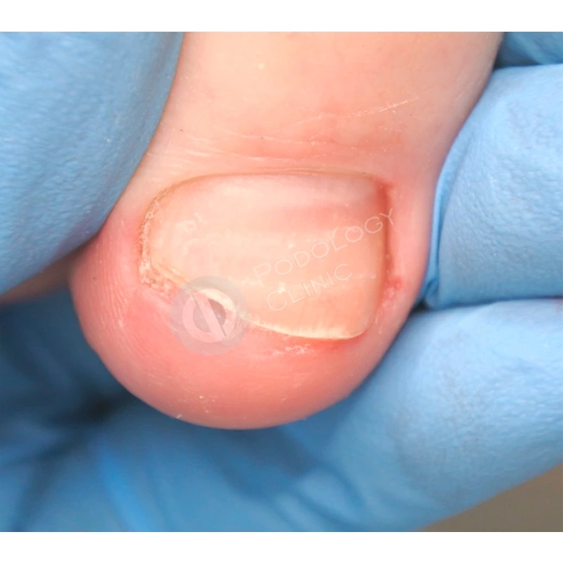 деформация ногтя на пальце ноги