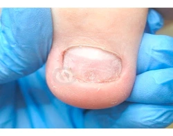 Лечение травм ногтя и ногтевого ложа