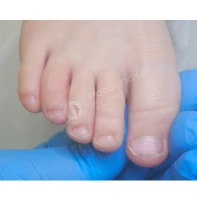 Как и чем лечить грибок на ногах у ребенка: статьи клиники Оксфорд Медикал Киев