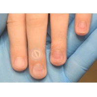 Продольные борозды на ногтях рук и ног – симптомы, причины, лечение и профилактика