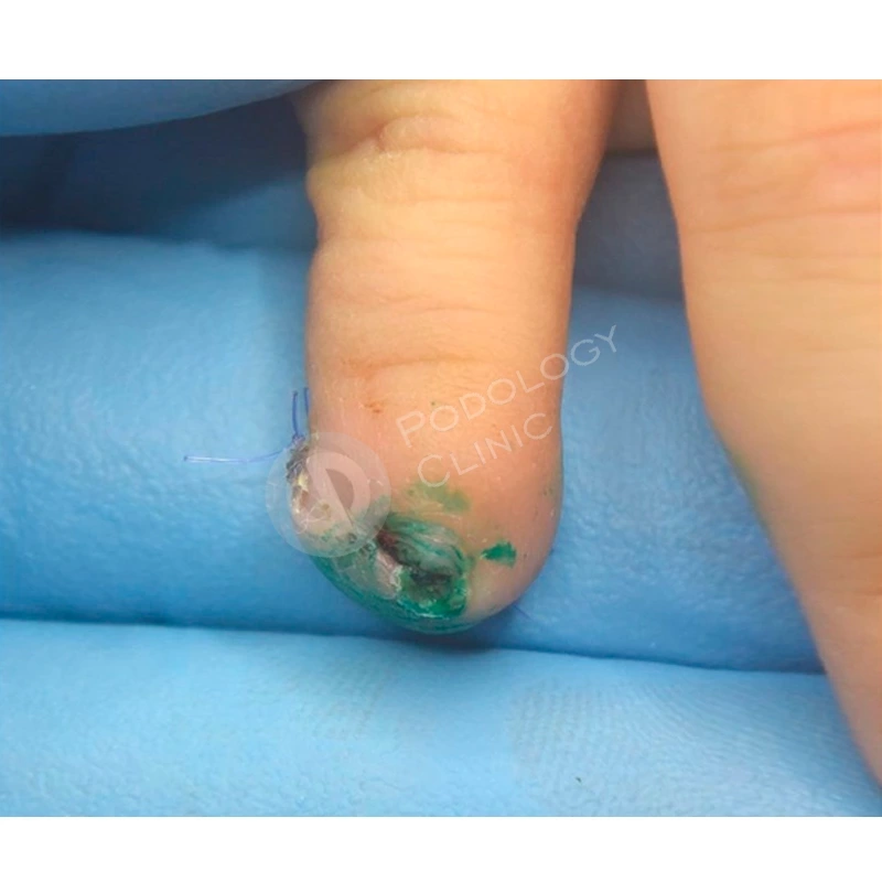 Ноготь с пальца слез у 3-летнего ребёнка во время игры в детсаду Читы