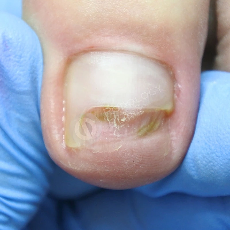 Признаки ушиба и перелома пальца ноги